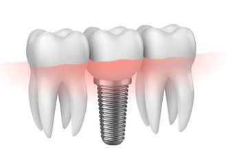 Implantate und Implantatprothetik